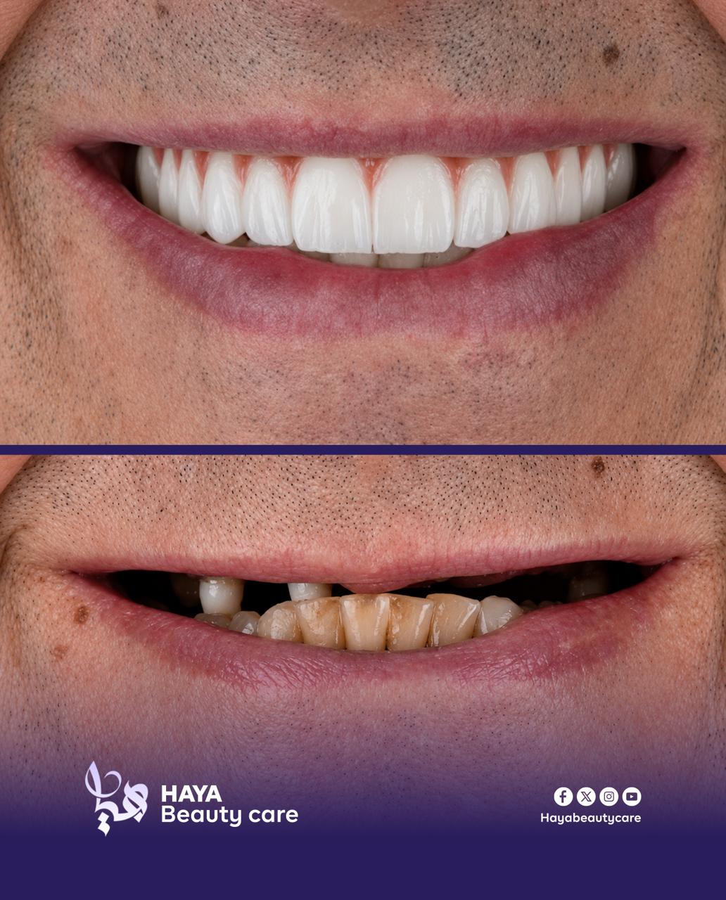 Smile makeover result, before and after