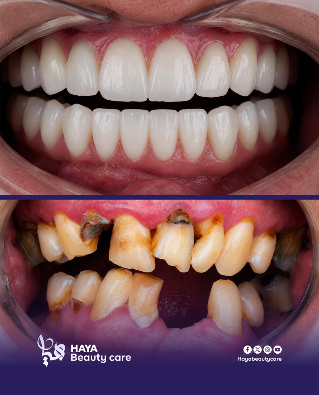 Veneers transformation, before and after