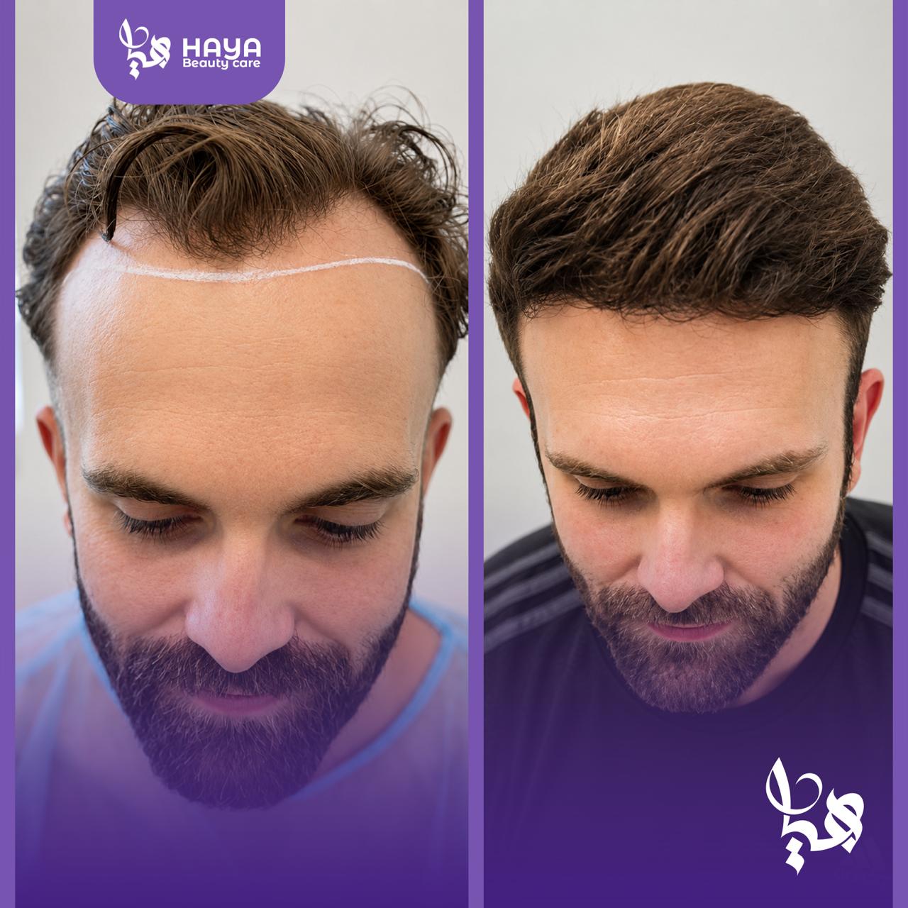Hair restoration, before and after